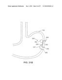 Gastric Simulation Anchor and Method diagram and image