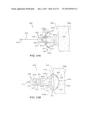 Gastric Simulation Anchor and Method diagram and image