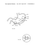 Gastric Simulation Anchor and Method diagram and image