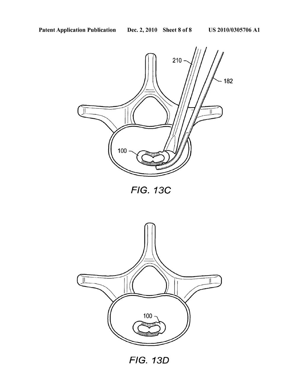 SPINAL IMPLANT - diagram, schematic, and image 09