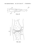 Patient Selectable Knee Joint Arthroplasty Devices diagram and image