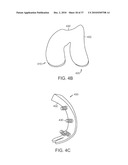 Patient Selectable Knee Joint Arthroplasty Devices diagram and image