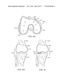 Patient Selectable Knee Joint Arthroplasty Devices diagram and image