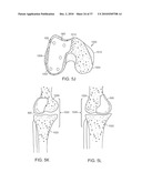 Patient Selectable Knee Joint Arthroplasty Devices diagram and image