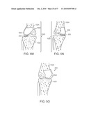 Patient Selectable Knee Joint Arthroplasty Devices diagram and image