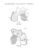 Patient Selectable Knee Joint Arthroplasty Devices diagram and image