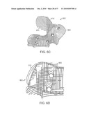 Patient Selectable Knee Joint Arthroplasty Devices diagram and image