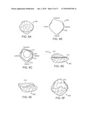 Patient Selectable Knee Joint Arthroplasty Devices diagram and image