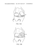 Patient Selectable Knee Joint Arthroplasty Devices diagram and image