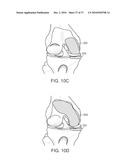 Patient Selectable Knee Joint Arthroplasty Devices diagram and image