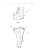 Methods and Apparatus for Performing Knee Arthroplasty diagram and image