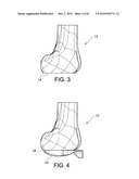 Methods and Apparatus for Performing Knee Arthroplasty diagram and image