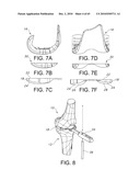 Methods and Apparatus for Performing Knee Arthroplasty diagram and image