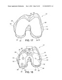 Methods and Apparatus for Performing Knee Arthroplasty diagram and image