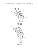 Methods and Apparatus for Performing Knee Arthroplasty diagram and image