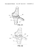 Methods and Apparatus for Performing Knee Arthroplasty diagram and image