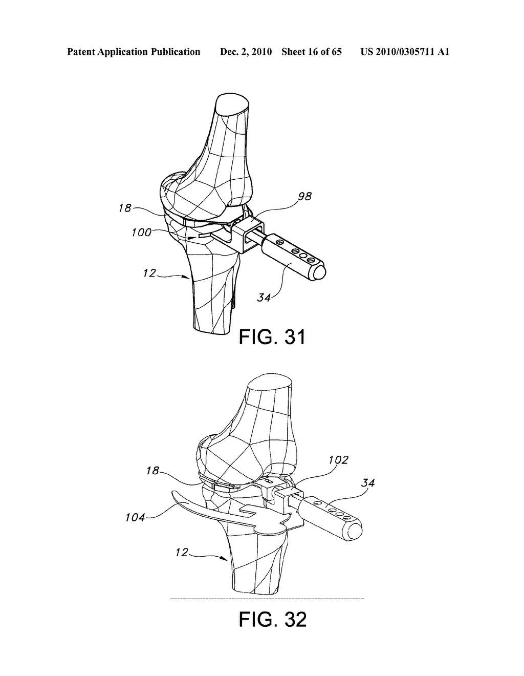 Methods and Apparatus for Performing Knee Arthroplasty - diagram, schematic, and image 17