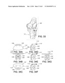 Methods and Apparatus for Performing Knee Arthroplasty diagram and image