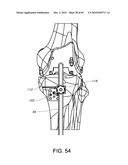 Methods and Apparatus for Performing Knee Arthroplasty diagram and image