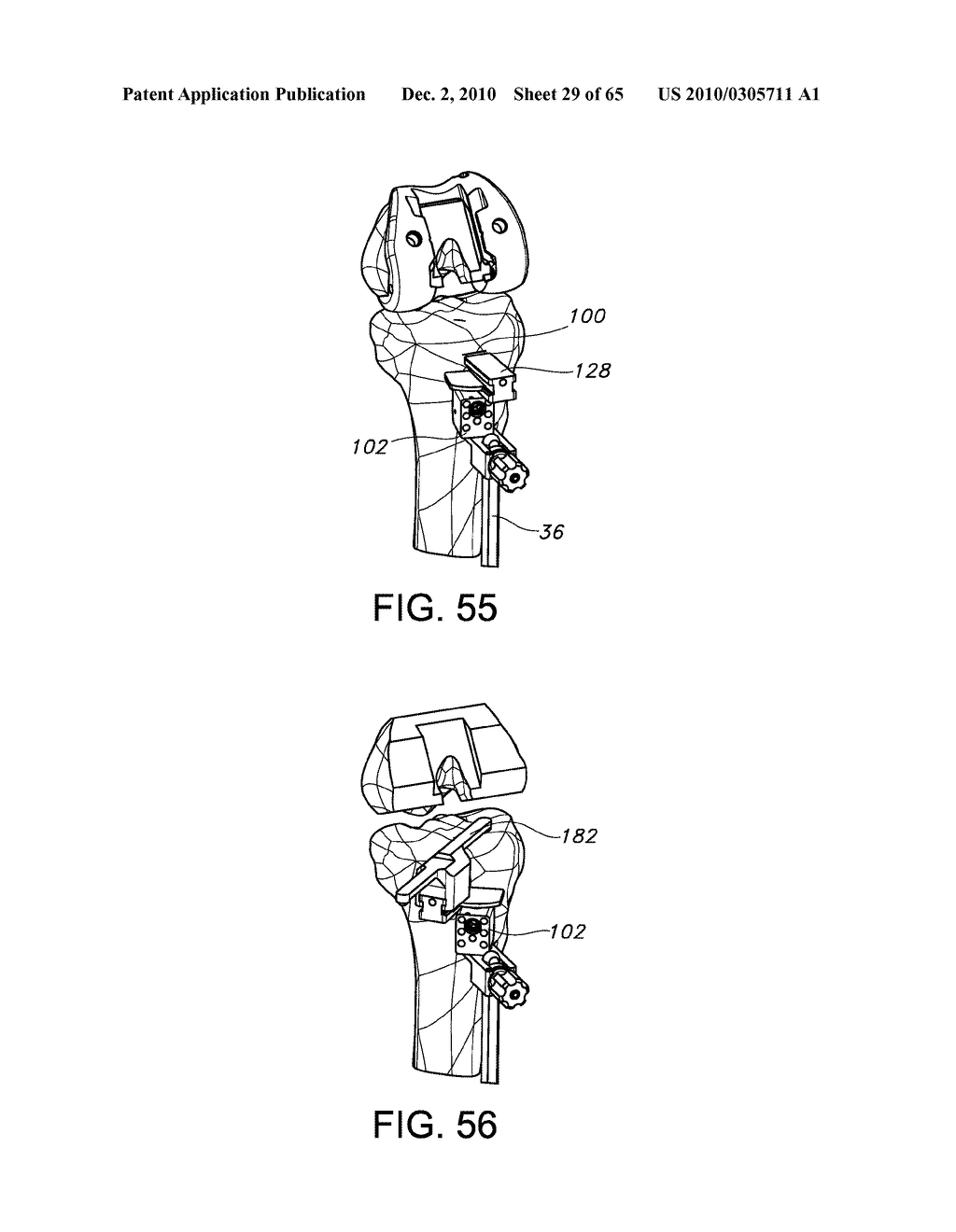 Methods and Apparatus for Performing Knee Arthroplasty - diagram, schematic, and image 30