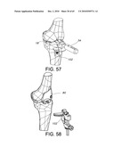 Methods and Apparatus for Performing Knee Arthroplasty diagram and image