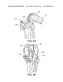 Methods and Apparatus for Performing Knee Arthroplasty diagram and image