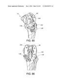 Methods and Apparatus for Performing Knee Arthroplasty diagram and image