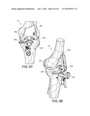 Methods and Apparatus for Performing Knee Arthroplasty diagram and image