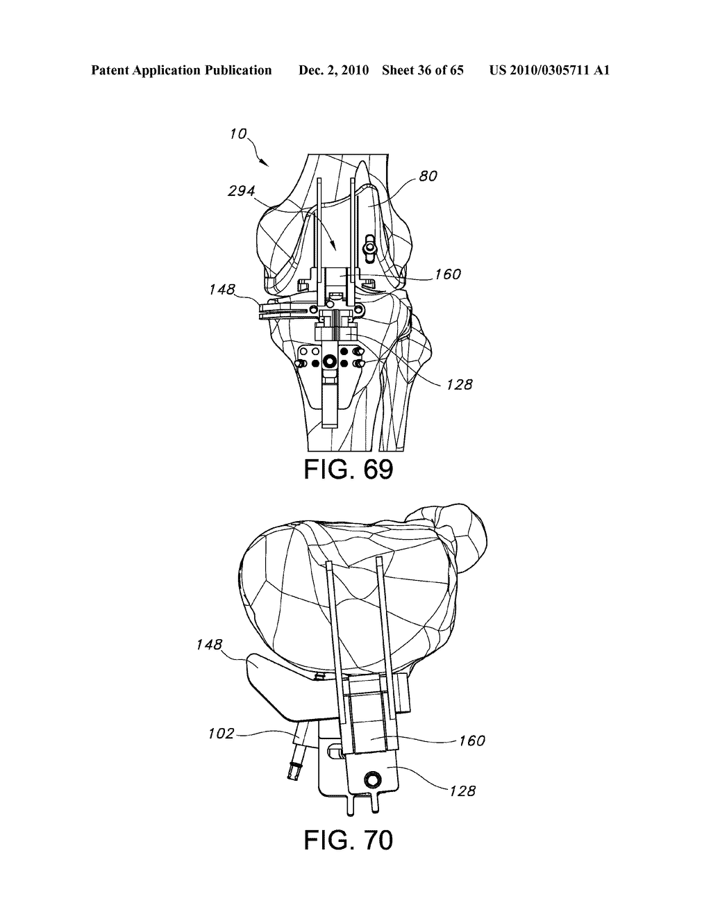 Methods and Apparatus for Performing Knee Arthroplasty - diagram, schematic, and image 37