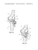 Methods and Apparatus for Performing Knee Arthroplasty diagram and image