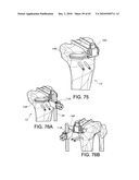 Methods and Apparatus for Performing Knee Arthroplasty diagram and image