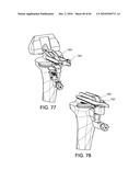 Methods and Apparatus for Performing Knee Arthroplasty diagram and image