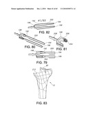 Methods and Apparatus for Performing Knee Arthroplasty diagram and image