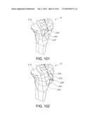 Methods and Apparatus for Performing Knee Arthroplasty diagram and image