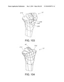 Methods and Apparatus for Performing Knee Arthroplasty diagram and image