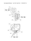 Methods and Apparatus for Performing Knee Arthroplasty diagram and image