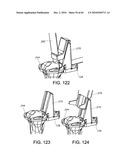 Methods and Apparatus for Performing Knee Arthroplasty diagram and image