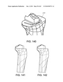 Methods and Apparatus for Performing Knee Arthroplasty diagram and image