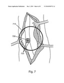 COMPRESSED POROUS MATERIALS SUITABLE FOR IMPLANT diagram and image