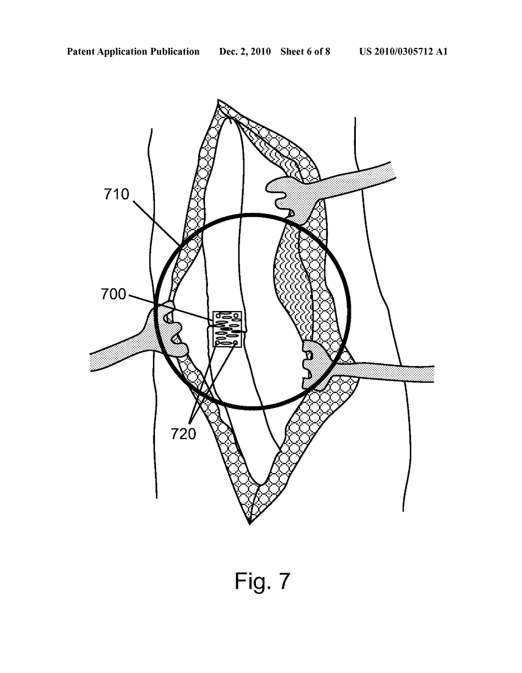 COMPRESSED POROUS MATERIALS SUITABLE FOR IMPLANT - diagram, schematic, and image 07