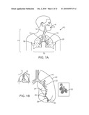 Cross-Sectional Modification During Deployment of an Elongate Lung Volume Reduction Device diagram and image