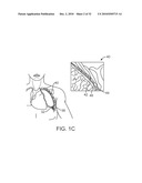 Cross-Sectional Modification During Deployment of an Elongate Lung Volume Reduction Device diagram and image