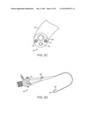 Cross-Sectional Modification During Deployment of an Elongate Lung Volume Reduction Device diagram and image