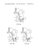 Cross-Sectional Modification During Deployment of an Elongate Lung Volume Reduction Device diagram and image