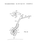 Cross-Sectional Modification During Deployment of an Elongate Lung Volume Reduction Device diagram and image