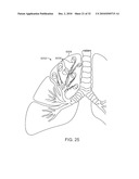 Cross-Sectional Modification During Deployment of an Elongate Lung Volume Reduction Device diagram and image