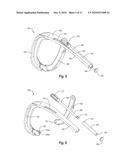 SALIVARY DUCT CONSTRICTION APPARATUS diagram and image