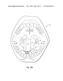 SALIVARY DUCT CONSTRICTION APPARATUS diagram and image