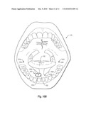 SALIVARY DUCT CONSTRICTION APPARATUS diagram and image