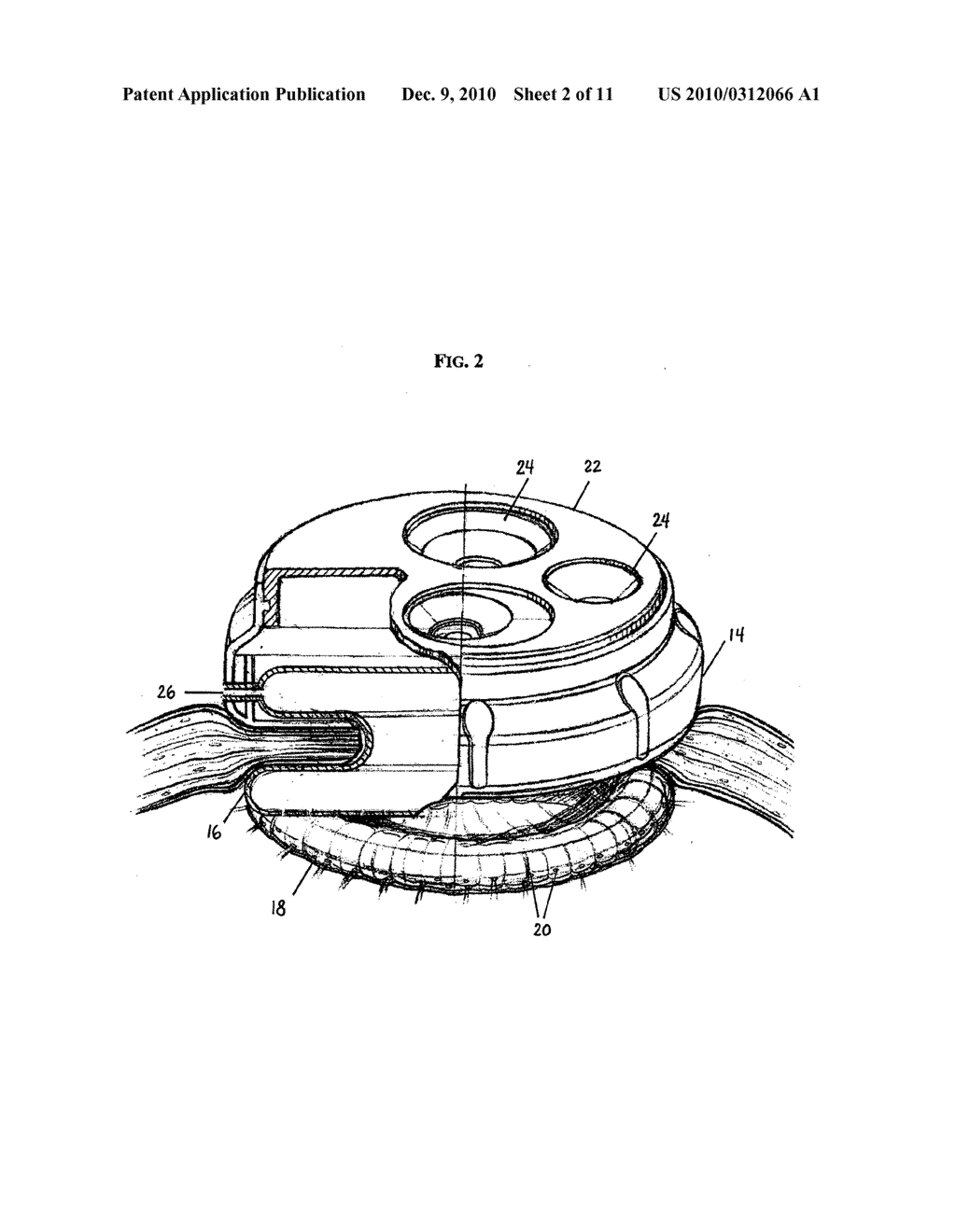 INFLATABLE RETRACTOR WITH INSUFFLATION - diagram, schematic, and image 03